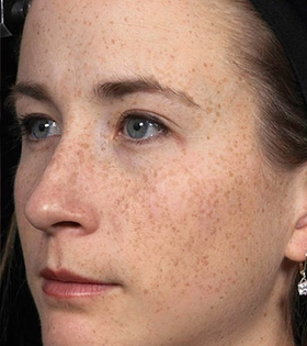 Лазерное омоложение кожи - фото до