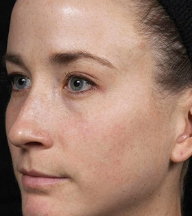 Лазерное омоложение кожи - фото після