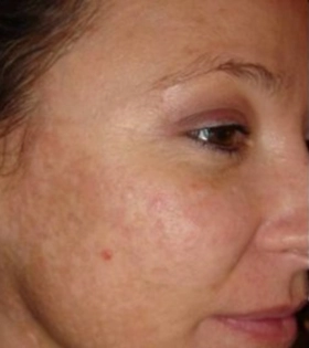 Лазерное омоложение кожи - фото до