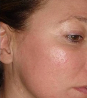 Лазерное омоложение кожи - фото після