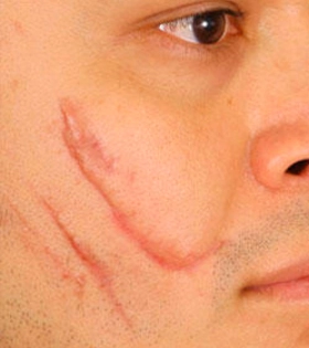 Лазерная шлифовка рубца - фото до