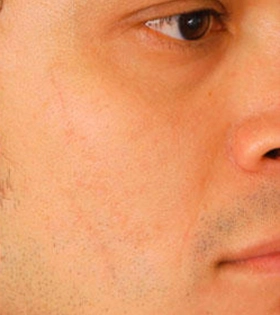 Лазерная шлифовка рубца - фото після