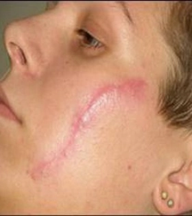 Лазерная шлифовка рубца - фото до