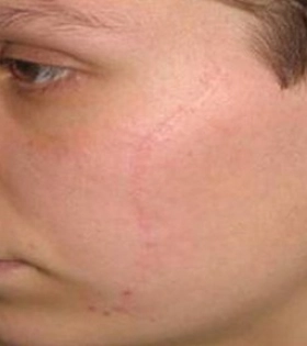 Лазерная шлифовка рубца - фото після