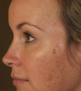 Лазерная шлифовка постакне - фото до