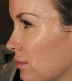 Лазерная шлифовка постакне - фото після