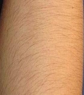 Лазерна епіляція рук в Одесі - фото до