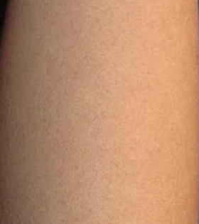 Лазерна епіляція рук в Одесі - фото після