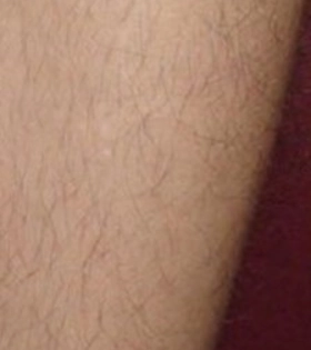 Лазерная эпиляция ног - фото до