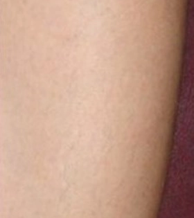 Лазерная эпиляция ног - фото після