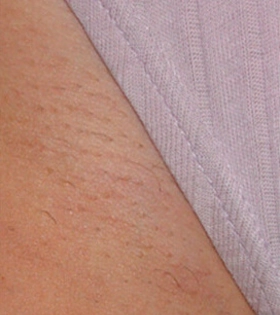 Лазерна епіляція бікіні в Одесі - фото після