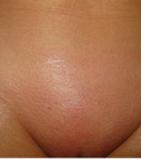 Лазерна епіляція бікіні в Одесі - фото після