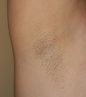 Лазерна епіляція пахв в Одесі. - фото до