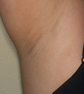 Лазерна епіляція пахв в Одесі. - фото після