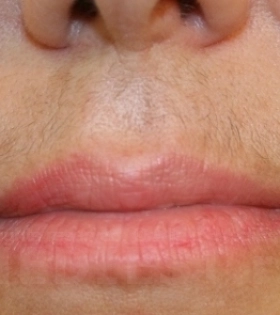 Лазерная эпиляция верхней губы - фото до