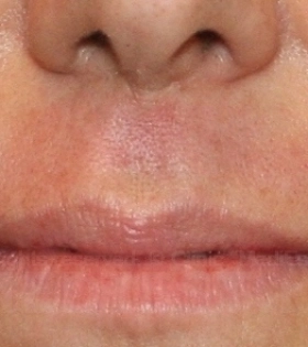 Лазерная эпиляция верхней губы - фото після