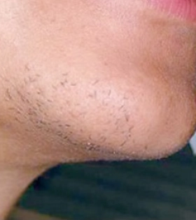 Лазерная эпиляция  - фото до