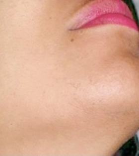 Лазерная эпиляция  - фото після