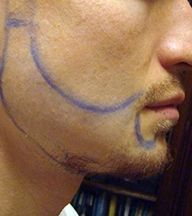 Пересадка бровей и бороды - фото до