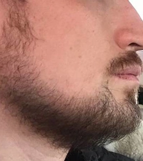 Пересадка бровей и бороды - фото після