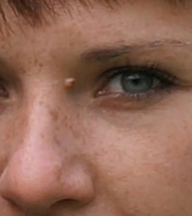 Удаление папилломы в периорбитальной области Врач Белялова З. - фото до