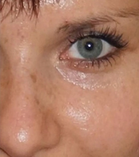 Удаление папилломы в периорбитальной области Врач Белялова З. - фото після