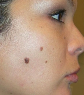 Удаление родинки (невуса)  Врач Котик Н. - фото до