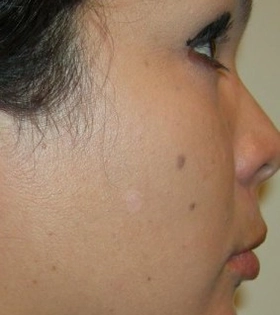 Удаление родинки (невуса)  Врач Котик Н. - фото після