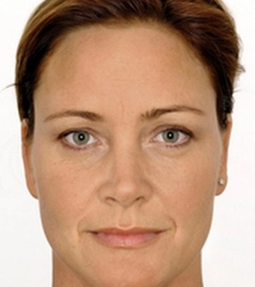 Биоревитализация лица в Одессе - фото до