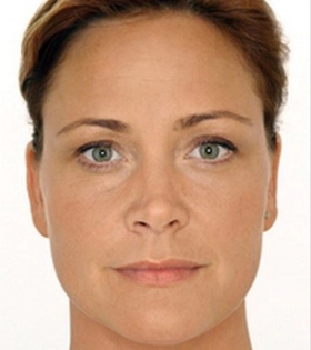 Биоревитализация лица в Одессе - фото после