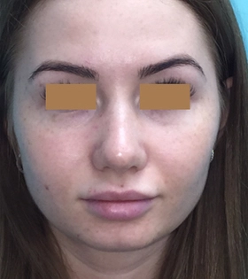 Липосакция щек - фото до