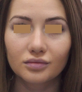 Липосакция щек - фото після