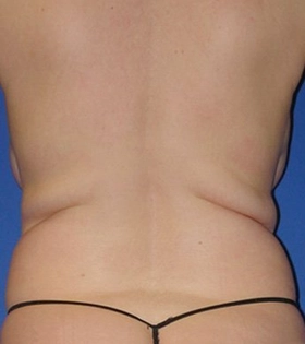 Vaser липосакция спины - фото до