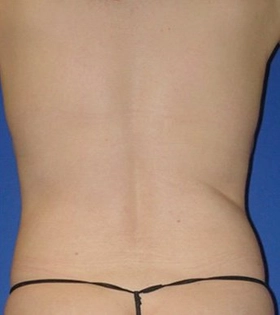 Vaser липосакция спины - фото після