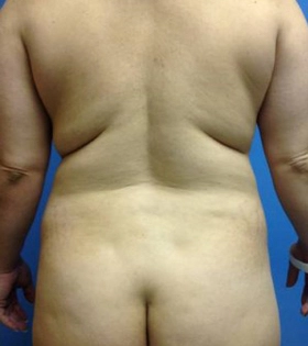 Vaser липосакция спины - фото до