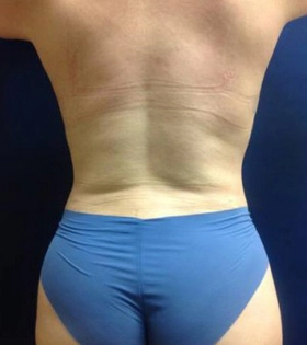 Vaser липосакция спины - фото після