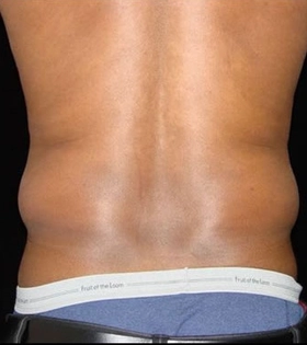 Липосакция боков - фото до