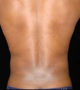 Липосакция боков - фото після