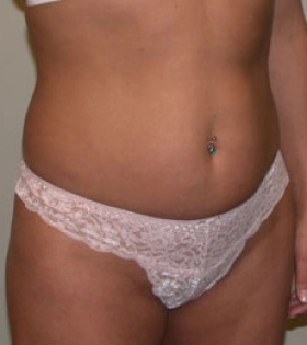 Липосакция боков - фото до