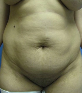 Липосакция живота - фото до