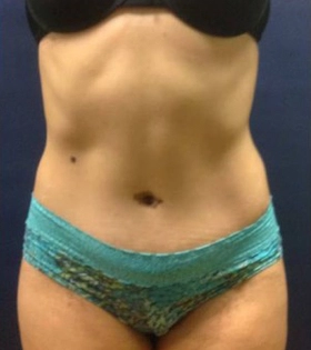 Липосакция живота - фото після