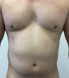 Липосакция живота - фото до