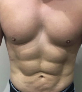 Липосакция живота - фото після