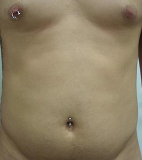 Липосакция живота - фото до