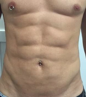 Липосакция живота - фото після