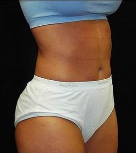 Липосакция живота - фото до