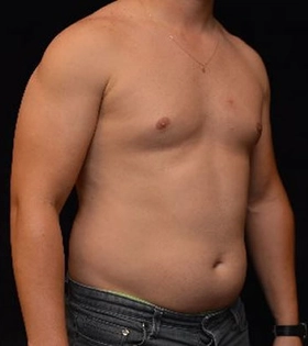 Липосакция живота - фото до