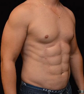 Липосакция живота - фото після