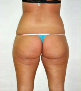 Липосакция ягодиц - фото до