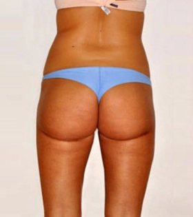 Липосакция ягодиц - фото після